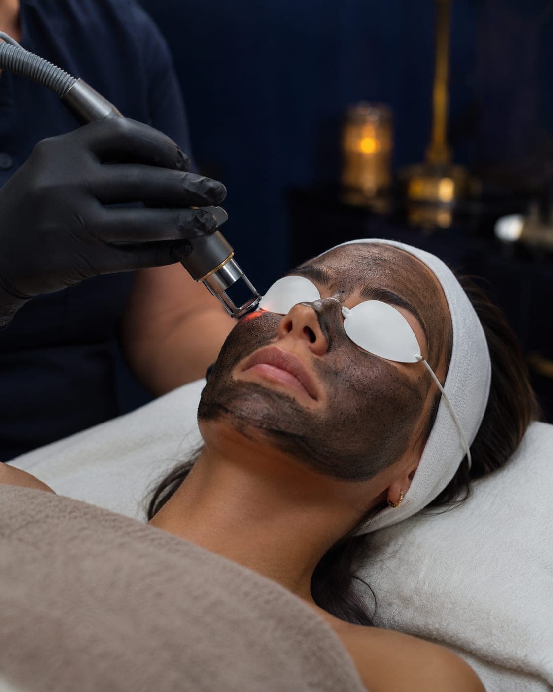 Carbon Yag Laser "Hollywood Peel" in progress — activated carbon mask treated with a Q-switched Nd:YAG laser at 360 Radiance