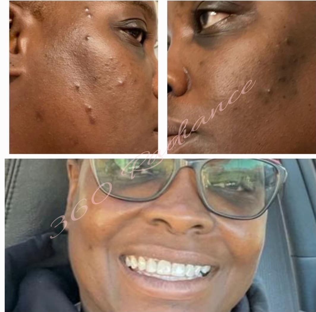Client before and after acne treatment — clearer skin and a confident smile after the 12-week program