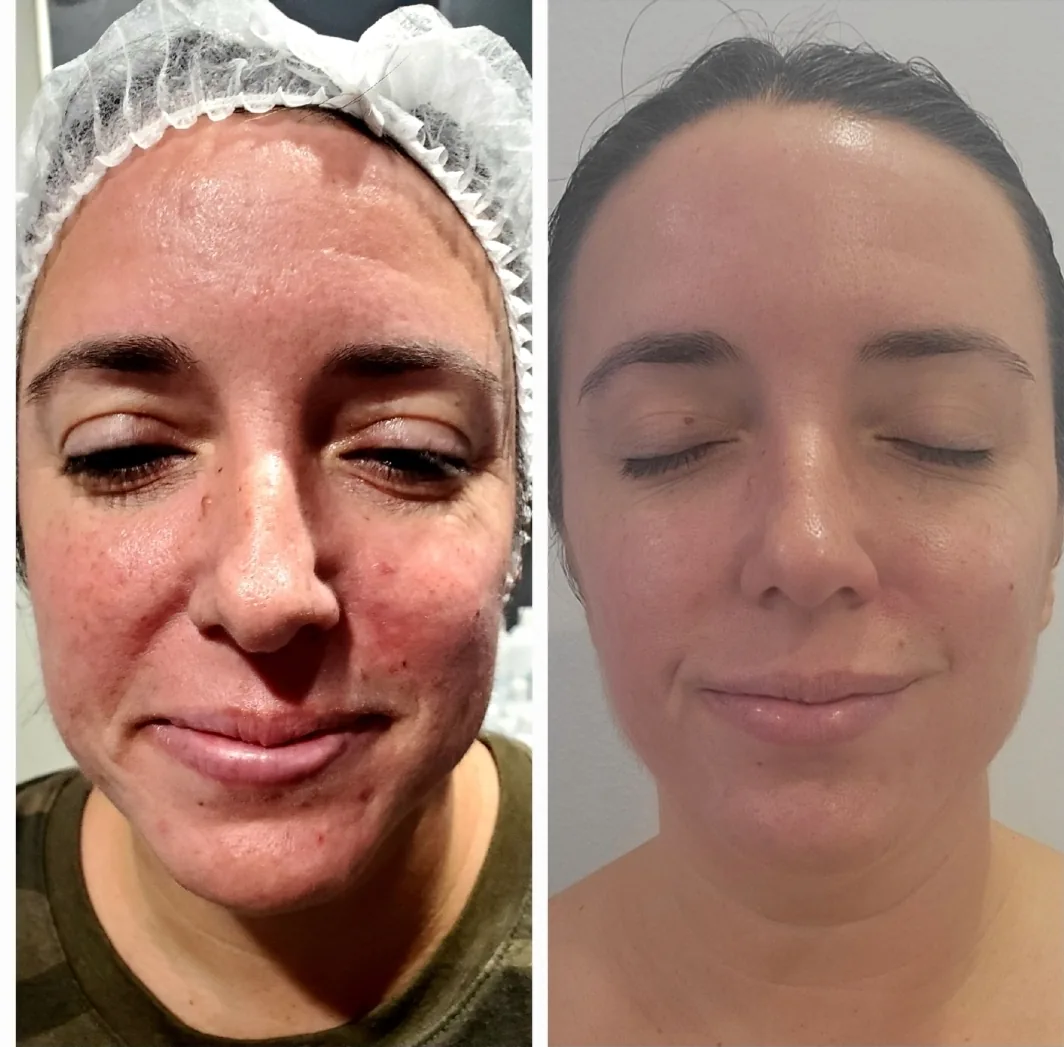 Before and after — cystic acne treatment, real 360 Radiance client