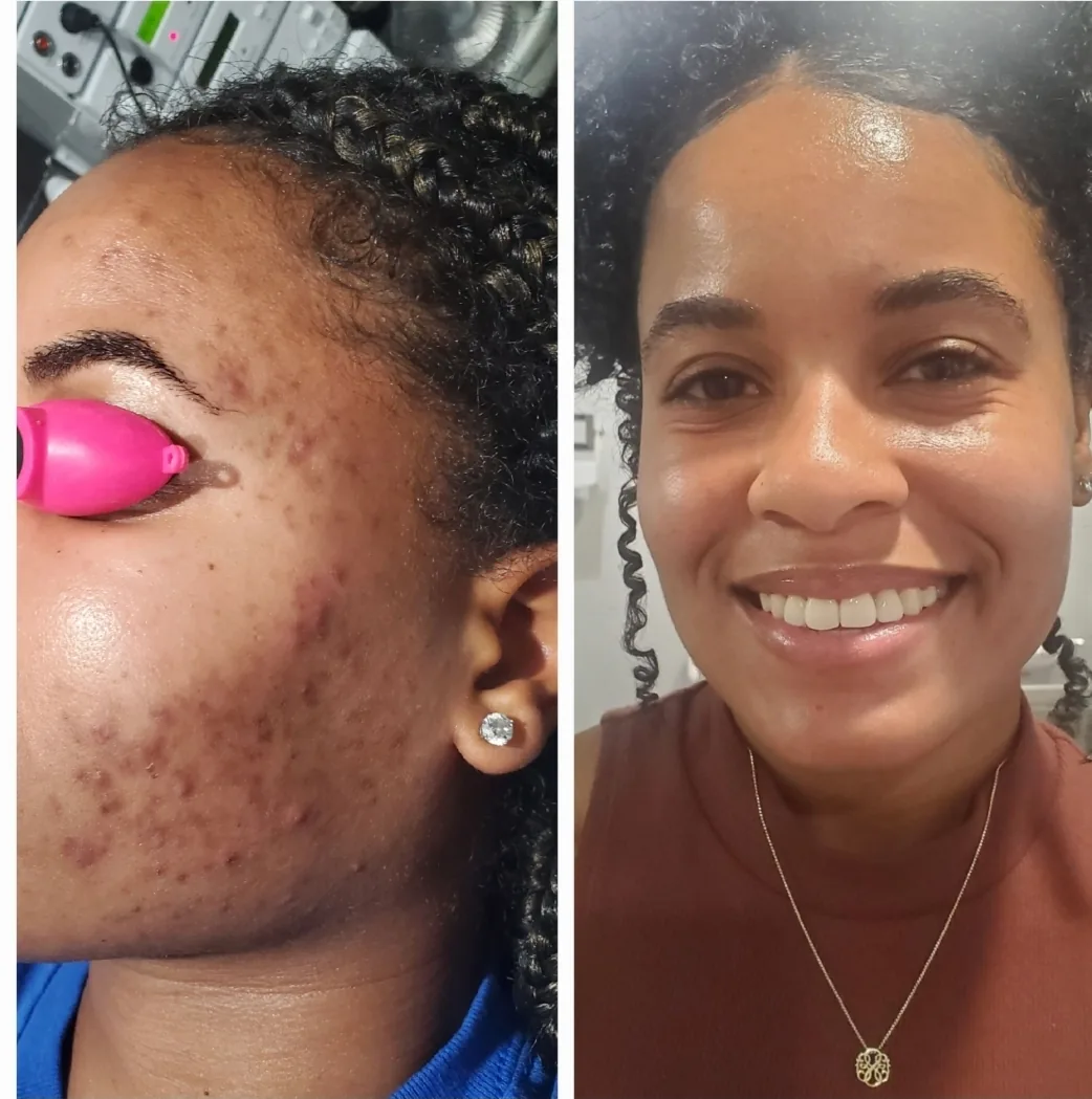 Real client before and after the 12-week Acne Treatment Program at 360 Radiance