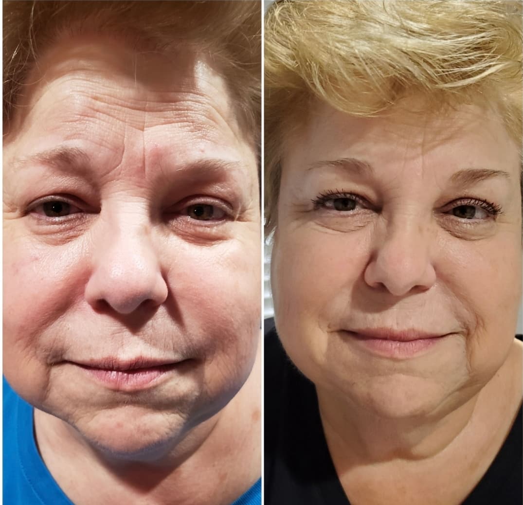 Client before and after anti-aging facial treatment — firmer, more lifted appearance