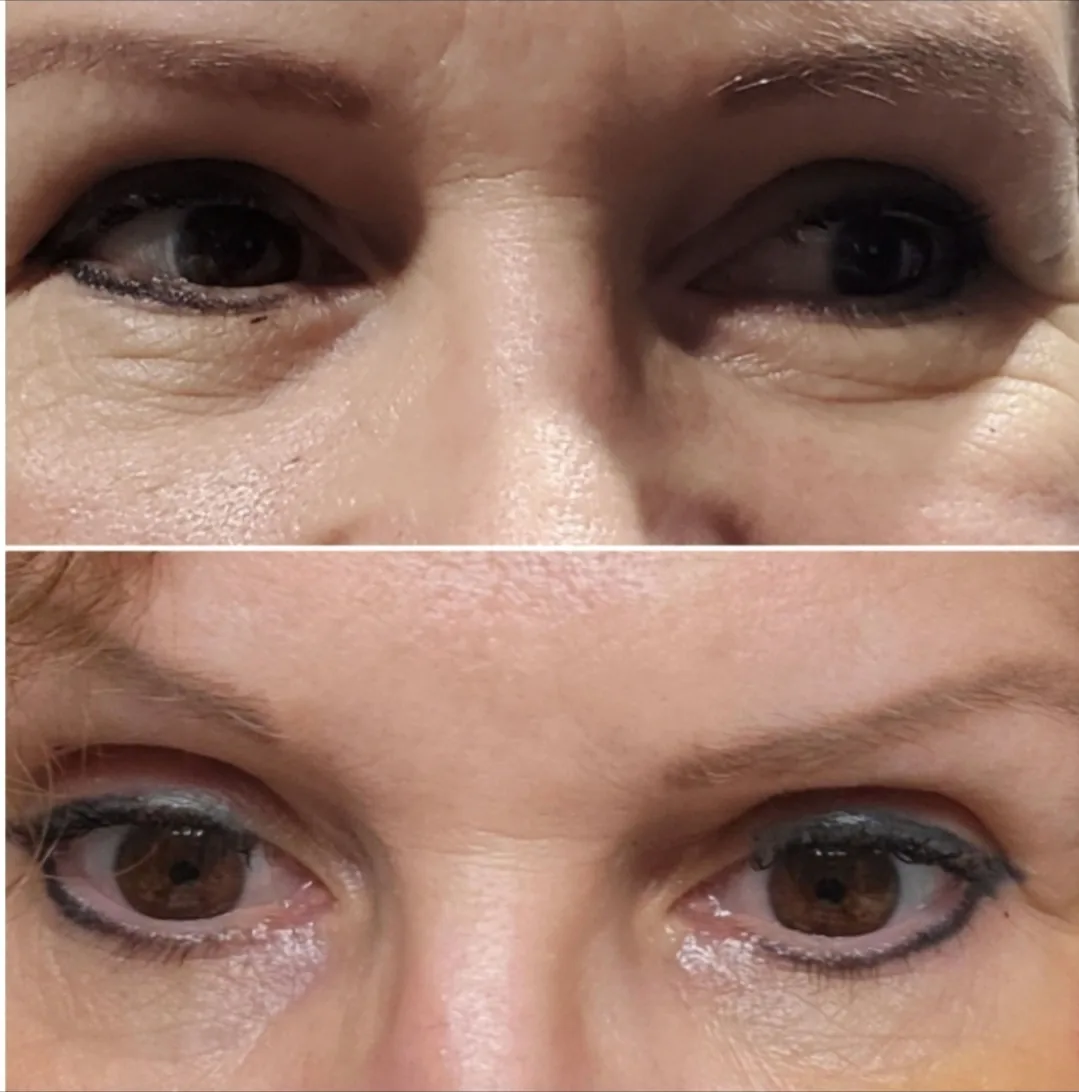 Client before and after eye area treatment — reduced fine lines and brighter under-eye