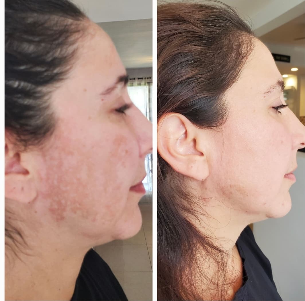Client before and after melasma and hyperpigmentation treatment — even, brighter skin tone