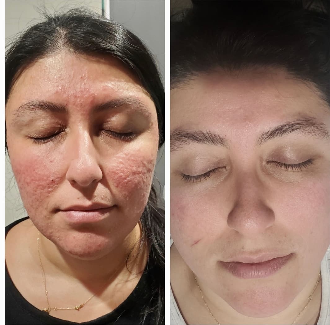 Client before and after rosacea treatment — calmed redness and even skin tone