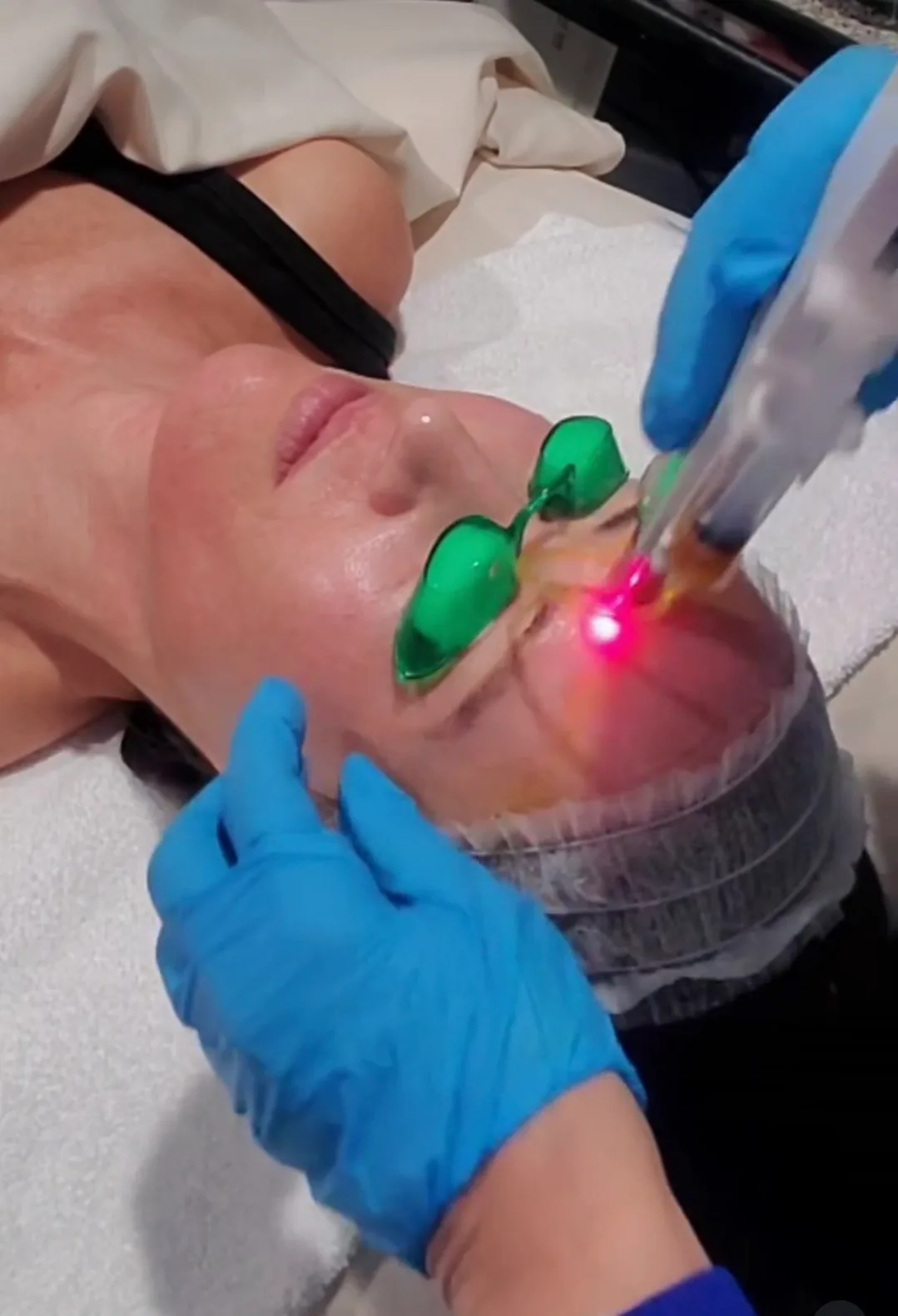 Q-switched Nd:YAG laser session for pigmentation and tattoo removal at 360 Radiance