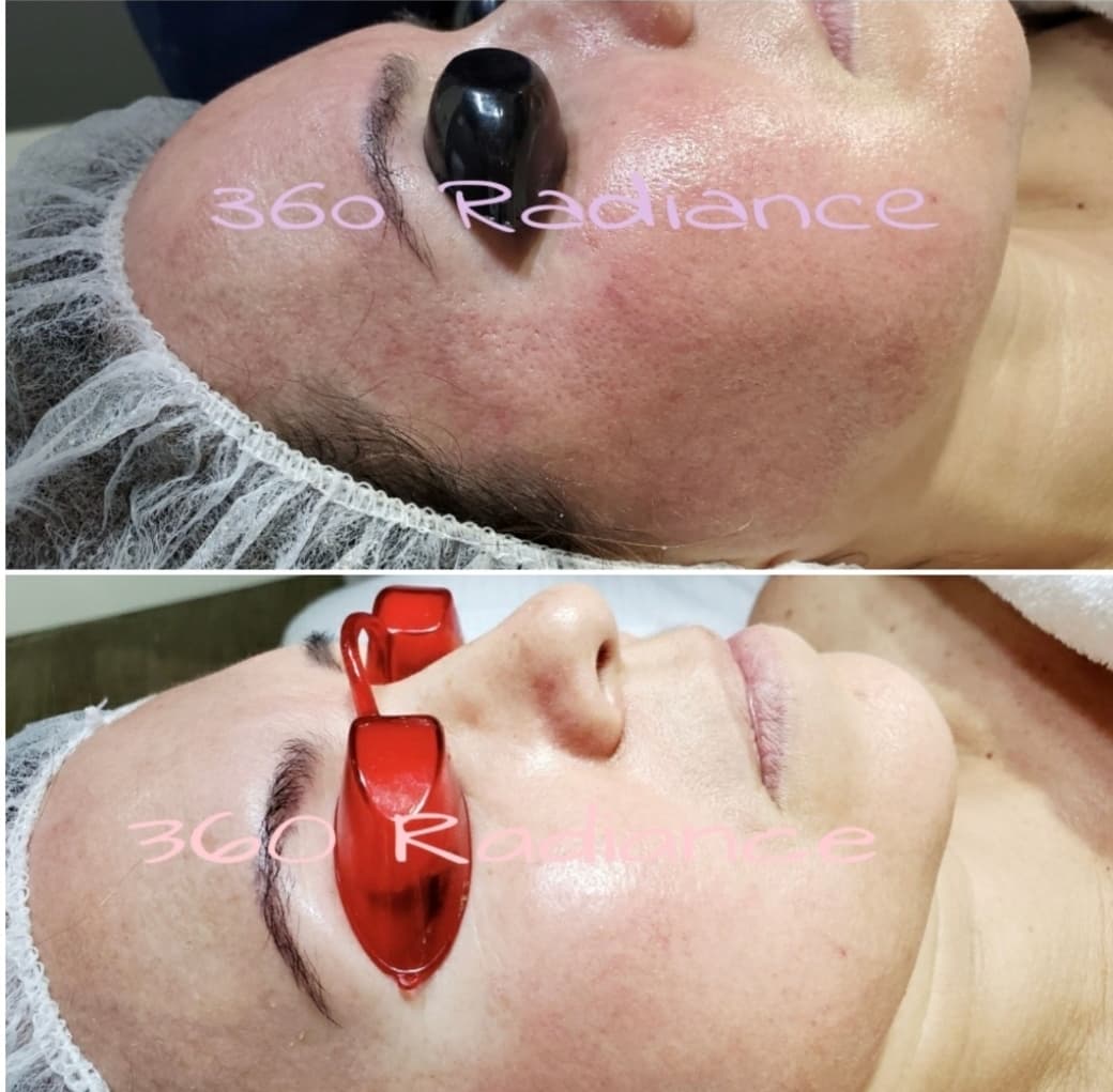 Medical-grade LED light therapy treatment in progress at 360 Radiance