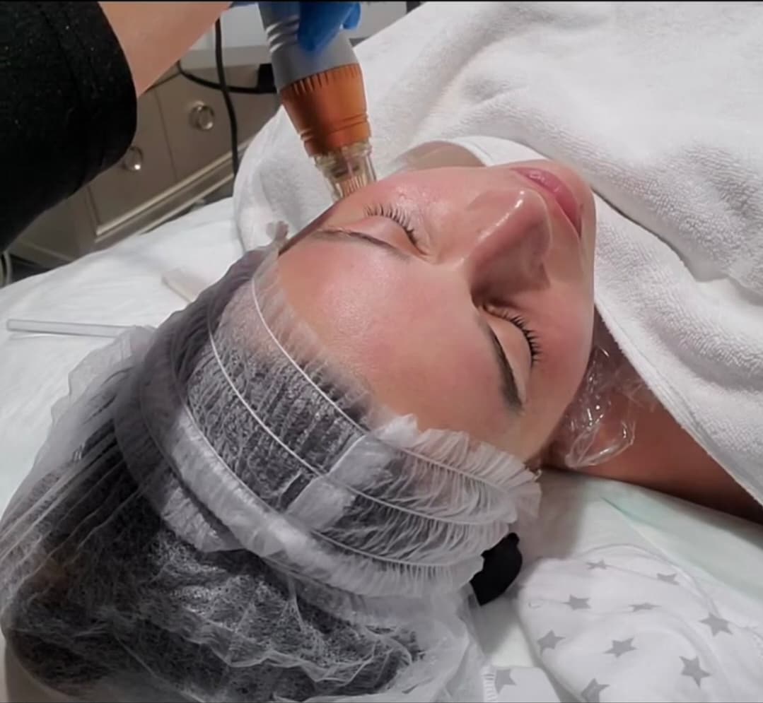Microneedling collagen induction therapy in progress at 360 Radiance